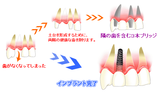 前歯を一本失った場合の治療